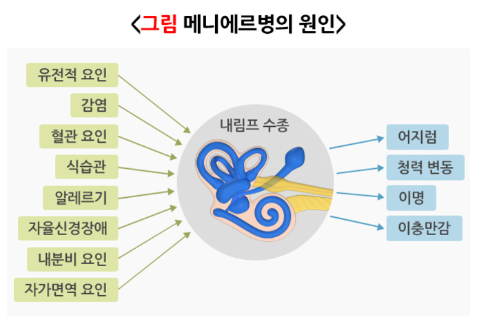 메니에르병의 원인을 설명하는 그림으로, 내림프 수종을 중심으로 유전적 요인, 감염, 혈관 요인, 식습관, 알레르기, 자율신경장애, 내분비 요인, 자가면역 요인이 원인으로 표시되어 있고, 결과로 어지럼, 청력 변동, 이명, 이충만감이 나타남을 보여줌.