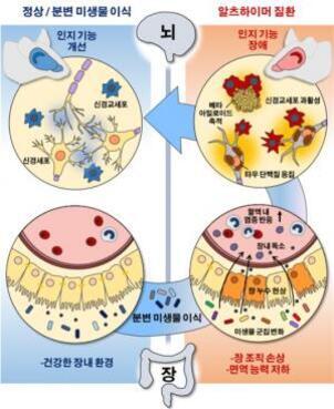 정상/분변 미생물 이식과 알츠하이머 질환의 뇌와 장 내 환경 변화를 비교한 다이어그램. 왼쪽은 건강한 장내 환경과 인지 기능 개선, 오른쪽은 장내 환경 악화와 인지 기능 장애, 뇌 신경세포 손상, 면역력 저하를 보여줌.